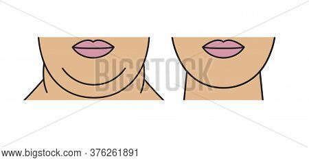 Double Chin, Restoration Of Facial Contours With Aid Liposuction, Weight Loss And Exercise. Rejuvena