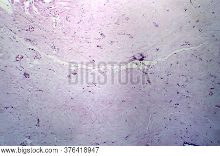 Uterus Adenofibroma, Light Micrograph, Photo Under Microscope. A Rare Benign Tumor Of The Uterus Com