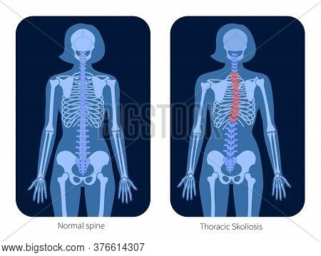 Normal Spine And Thoracic Scoliosis In Woman Body. Xray Flat Vector Illustration. Backbone And Skele