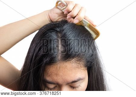 Women Head With Dandruff Caused By The Problem Of Dirty. Or Caused By Skin Disease Or Seborrheic Der