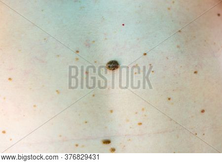 Problem Skin In A Man. Moles, Birthmark, Warts. Poor Health Concept.