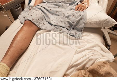Single Leg Of An Amputee Man In A Hospital Bed, Diabetes Cancer Blood Clots, Effects Of Coronavirus,