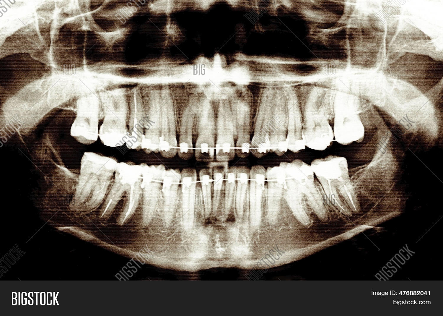 Dental Xray Braces. Image & Photo (Free Trial) Bigstock