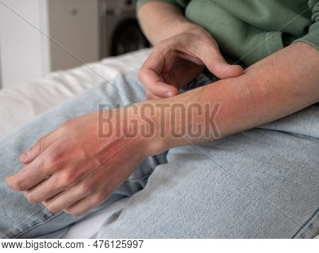 Man Scratches Hand, Red Damaged Skin. Excoriation Neurotic Disorder, Skin Scratching, Emotional Stre