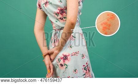 Macro Detailed Circles Magnification Psoriasis Arm Skin With Different Degrees Wounds. Dry Flaky Ski