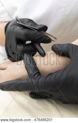 Closeup Process Of Permanent Unwanted Hair Removal On Foot, Toe, Using Electroepilation Device And T