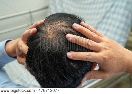 Bald In The Middle Head And Begin No Loss Hair Glabrous Of Mature Asian Business Smart Active Office