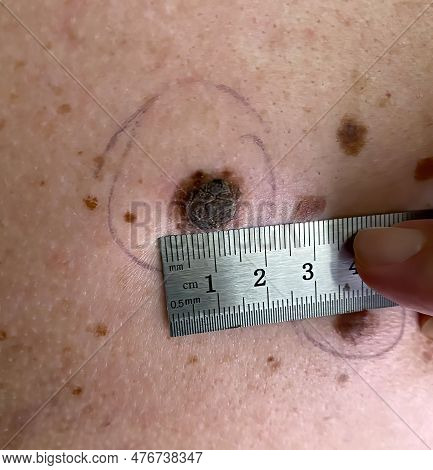 Measuring The Size Of A Mole On Human Skin.