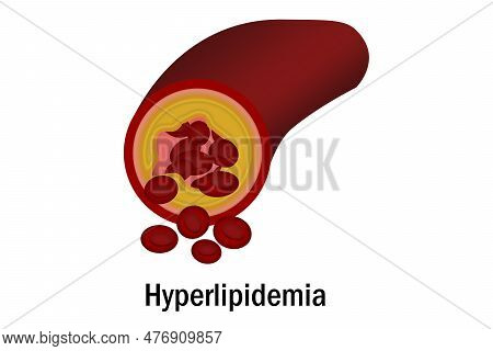 Hyperlipidemia With Blood Vessel Isolated, 3d Rendering