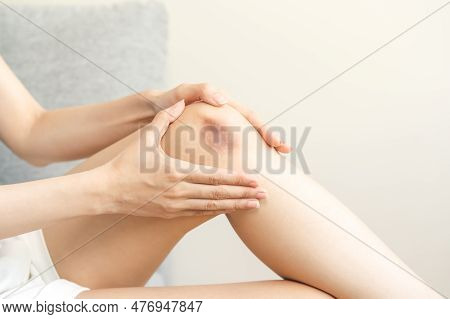 Close Up Of Stain Bruise Wound On Leg, Contusion Asian Young Woman, Girl On Joint Knee From An Accid