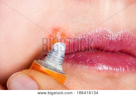 Herpes on the lip close-up macro. Woman lubricates the labial herpes ointment.