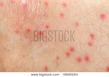 Mosquito Allergy On Human Skin