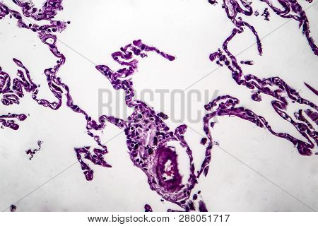 Histopathology Of Lung Emphysema, Light Micrograph, Photo Under Microscope Showing Enlargement Of Ai