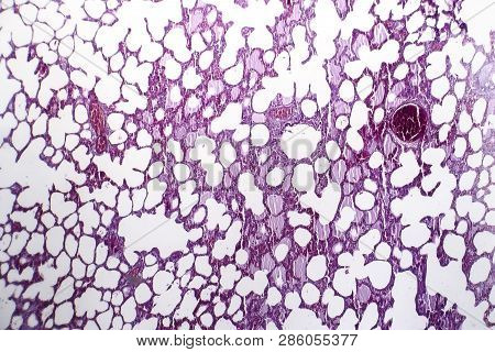 Histopathology Of Pneumonia, Light Micrograph, Photo Under Microscope