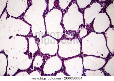 Histopathology Of Pneumonia, Light Micrograph, Photo Under Microscope. Cellulose Aspiration Pneumoni