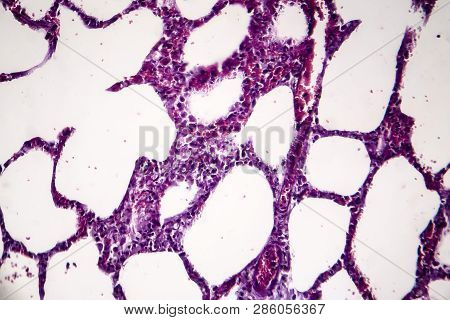Histopathology Of Pneumonia, Light Micrograph, Photo Under Microscope. Cellulose Aspiration Pneumoni