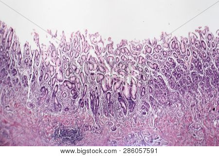 Histopathology Of Chronic Atrophic Gastritis, Light Micrograph, Photo Under Microscope