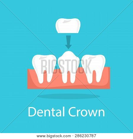 Tooth Crown. Dentistry And Implant Procedure Concept