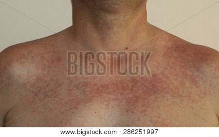 Photocontact Dermatitis Or Photodermatitis Induced By Ultraviolet Radiation