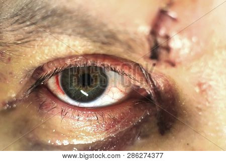 Eye Injury Bruises And Bruises. A Blow To The Eye