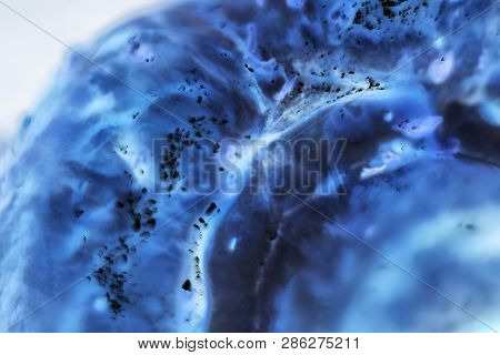 Cancer Cells Under A Microscope. Tissues Affected By Cancer Cells Under The Microscope, Science. Can