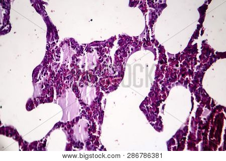 Histopathology Of Pneumonia, Light Micrograph, Photo Under Microscope. Cellulose Aspiration Pneumoni