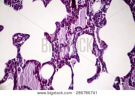 Histopathology Of Pneumonia, Light Micrograph, Photo Under Microscope. Cellulose Aspiration Pneumoni