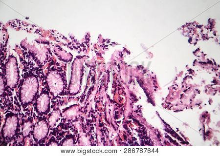 Histopathology Of Chronic Atrophic Gastritis, Light Micrograph, Photo Under Microscope