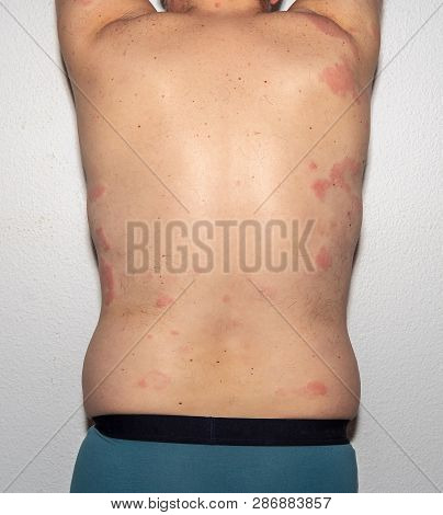 Allergy. Reaction. Health. Histamine. Intolerance
