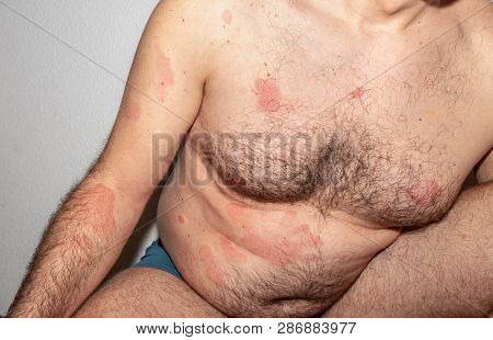 Histamine. Allergy. Reaction. Intolerance. Health