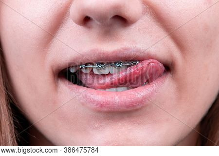 Happy Smiling Woman Licking Her Dental Braces On Teeth