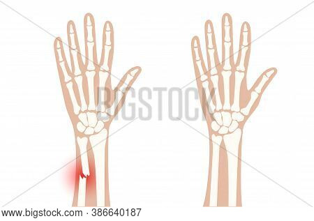 X Ray Of Arm Fracture With Red Pain Point And Normal Arm. Broken Hand With Inner Closed Greenstick T