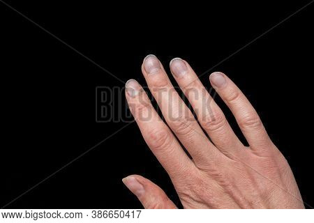 Close-up Of Female Caucasian Hand With Dirty Brittle Nails, Broken Nails On A Black Background. Peel