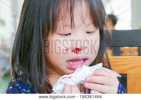 Little Asian Girl Wipe Her Bleeding Nose By Tissue Paper