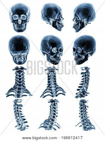 CT scan ( Computed tomography ) with 3D graphic show normal human skull and cervical spine . Multiple view .