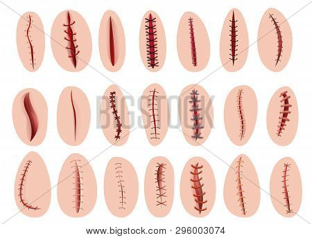 Suture Icons Set. Cartoon Set Of Suture Vector Icons For Web Design