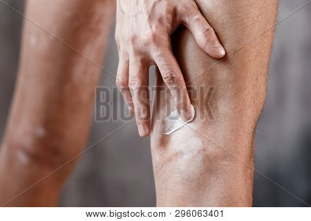 Vitiligo Close-up On The Legs Of A Man. A Young Guy Cares For The Skin, Smears The Skin With Pigment