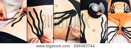 Treatment of skin laxity using kinesiology taping. Collage with the process of applying.