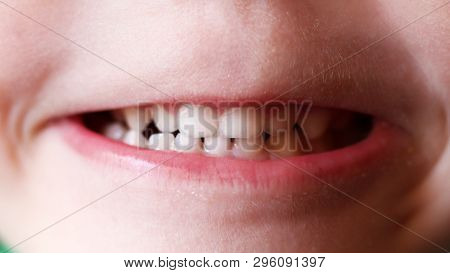 Mouth Of A 5 Years Old Boy. Closeup