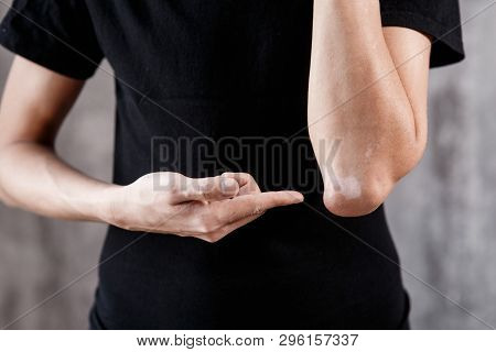 Vitiligo Close-up On The Hands And Elbows Of A Man