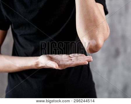 Vitiligo Close-up On The Hands And Elbows Of A Man