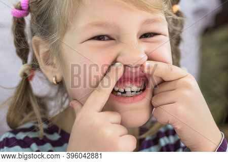 Adult Permanent Teeth Coming In Front Of The Child's Baby Teeth: Shark Teeth. Little Girl's Open Mou