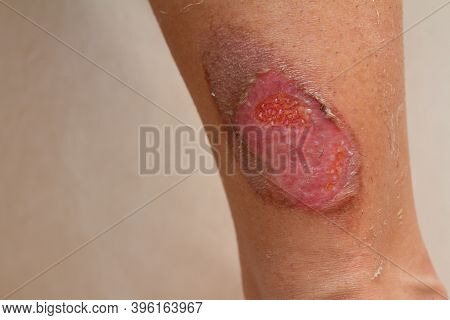 A Woman Suffering From A Second Degree Muffler Burn From A Motorcycle