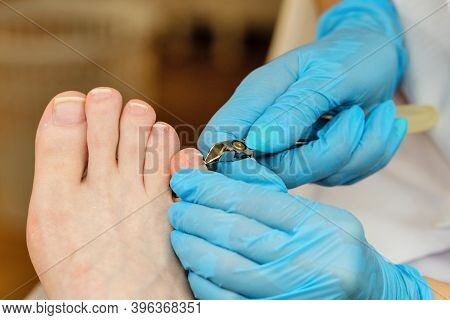 Master Chiropody Removes The Cuticle. Cuticle Treatment Is One Of The Stages Of Processing The Cutic