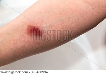 Injury To The Forearm From Scalding With Steam - Burn Wound