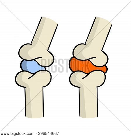 Arthritis. Disease Of Joints. Bones And Interosseous Cartilage. Biology And Anatomy. Medical Educati