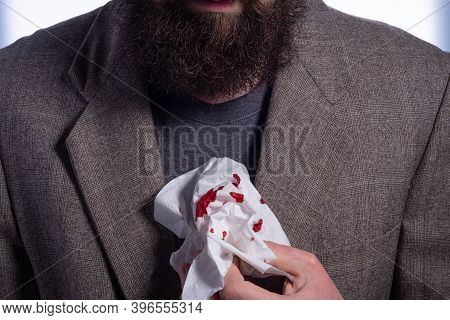 Bloody Runny Nose, A Man Businessman With A Beard Holding A Handkerchief In Blood In His Hand. Close