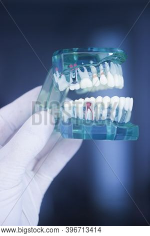 Tooth Decay Dental Model