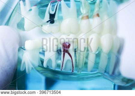 Tooth Decay Dental Model