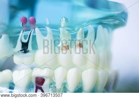 Tooth Decay Dental Model